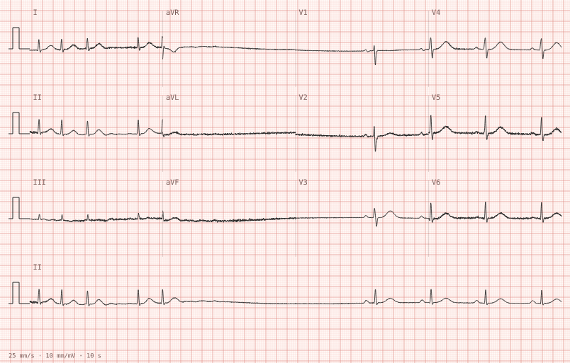 AF, conversion pause, sinus — synthetic ECG on millimetre paper