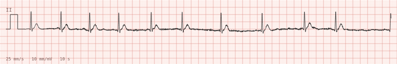 AF, rate-controlled — synthetic ECG on millimetre paper