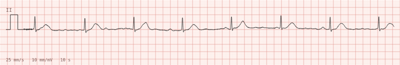 Regularised AF — synthetic ECG on millimetre paper