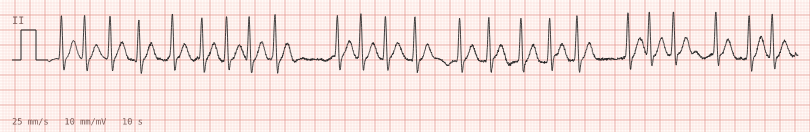 AF with rapid response — synthetic ECG on millimetre paper