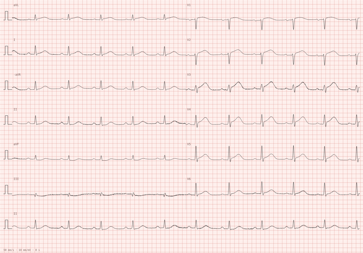 Anterior MI with Q waves — synthetic ECG on millimetre paper
