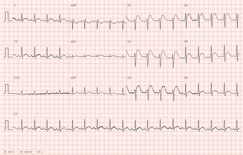 Anterior STEMI — synthetic ECG on millimetre paper