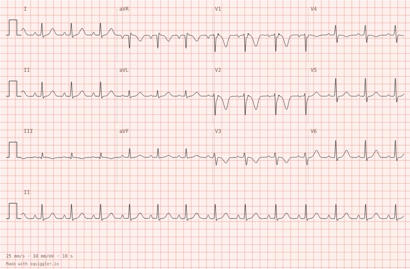ARVC — synthetic ECG on millimetre paper