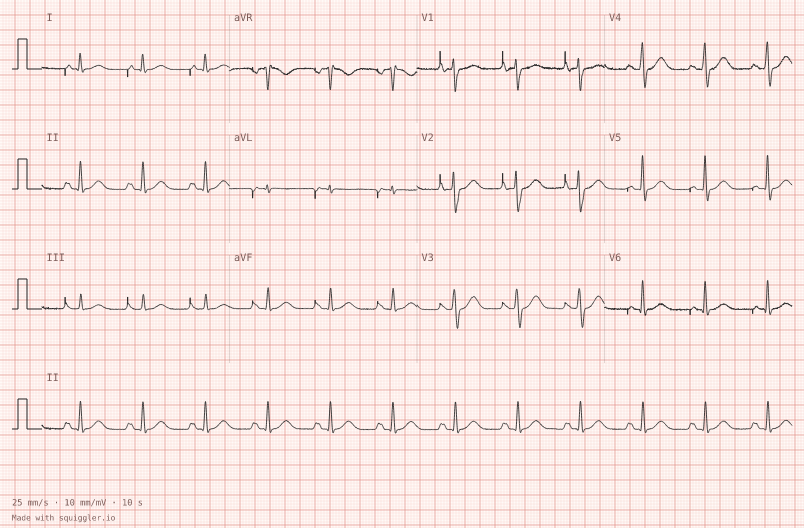 Atrial pacing — synthetic ECG on millimetre paper