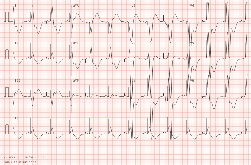 AV-sequential pacing — synthetic ECG on millimetre paper