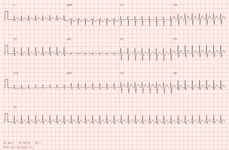 AVNRT — synthetic ECG on millimetre paper