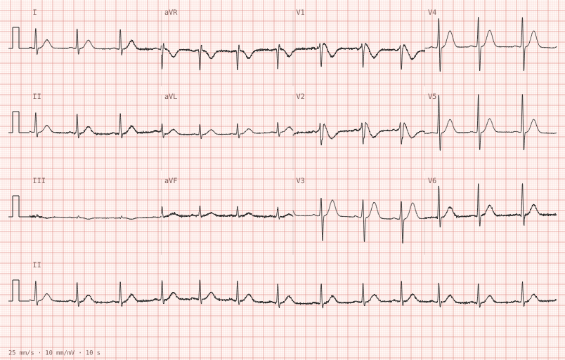 Brugada type 1 — synthetic ECG on millimetre paper