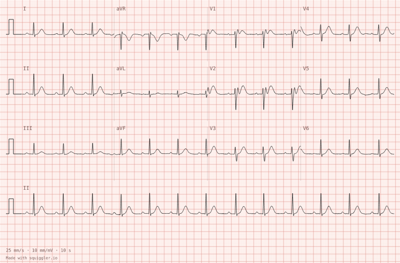 Brugada type 2 — synthetic ECG on millimetre paper