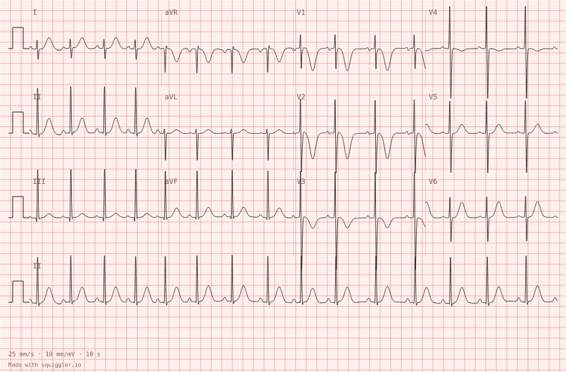 Six-year-old — synthetic ECG on millimetre paper