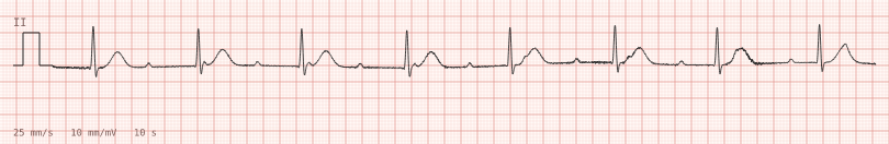 Complete block, narrow escape — synthetic ECG on millimetre paper
