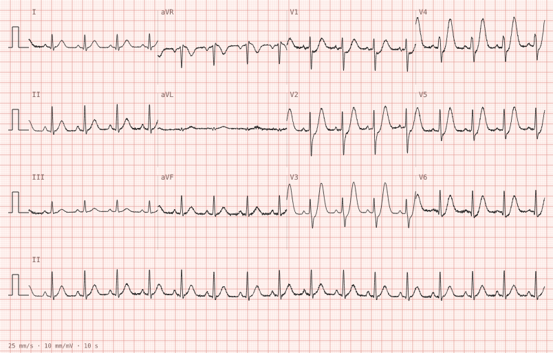 de Winter T waves — synthetic ECG on millimetre paper