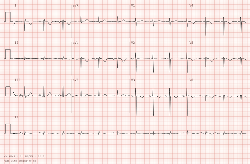Dextrocardia — synthetic ECG on millimetre paper