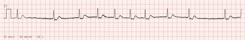 Digoxin effect — synthetic ECG on millimetre paper