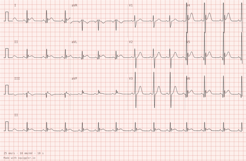 Early repolarisation — synthetic ECG on millimetre paper
