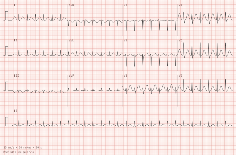 Ectopic atrial tachycardia — synthetic ECG on millimetre paper