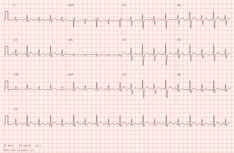 Electrical alternans — synthetic ECG on millimetre paper