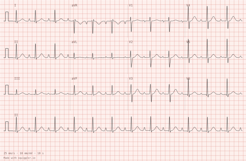 First-degree AV block — synthetic ECG on millimetre paper