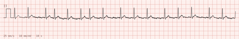 Flutter, variable block — synthetic ECG on millimetre paper