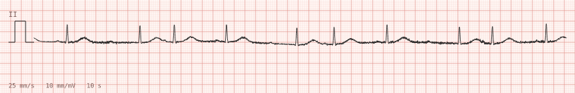 High-grade block with escape — synthetic ECG on millimetre paper