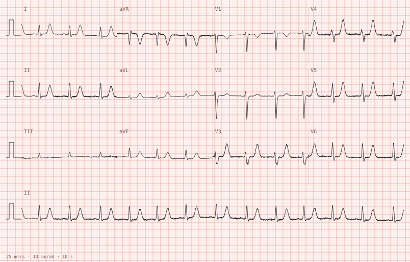 Hyperkalaemia — synthetic ECG on millimetre paper