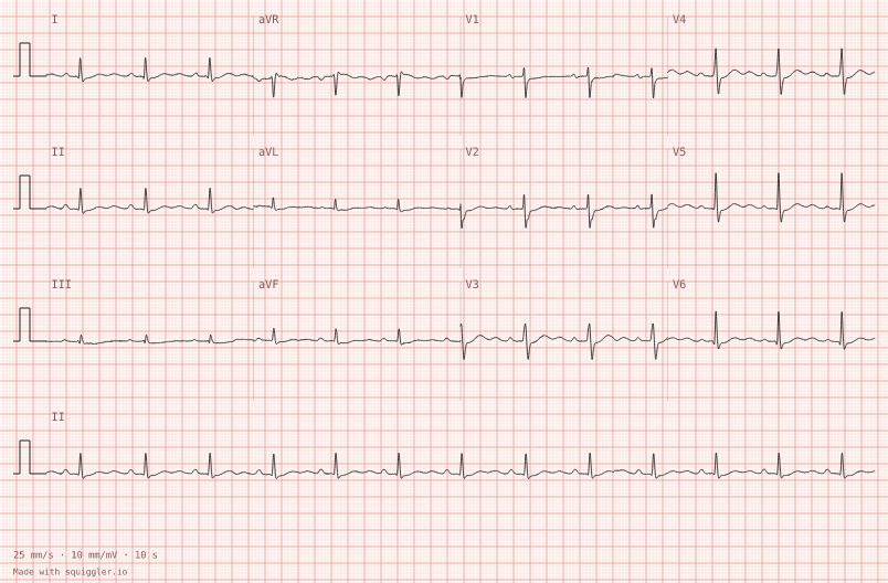 Hypokalaemia — synthetic ECG on millimetre paper