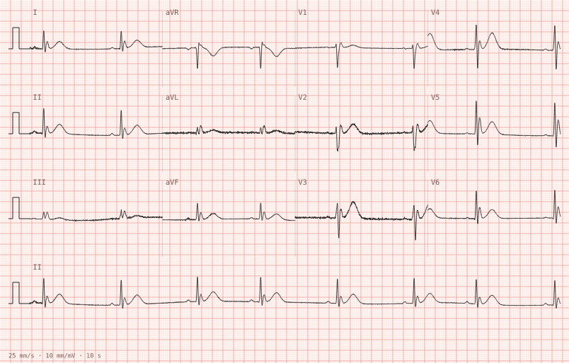 Hypothermia (Osborn) — synthetic ECG on millimetre paper