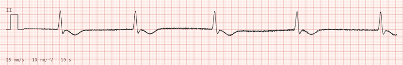 Idioventricular / agonal — synthetic ECG on millimetre paper