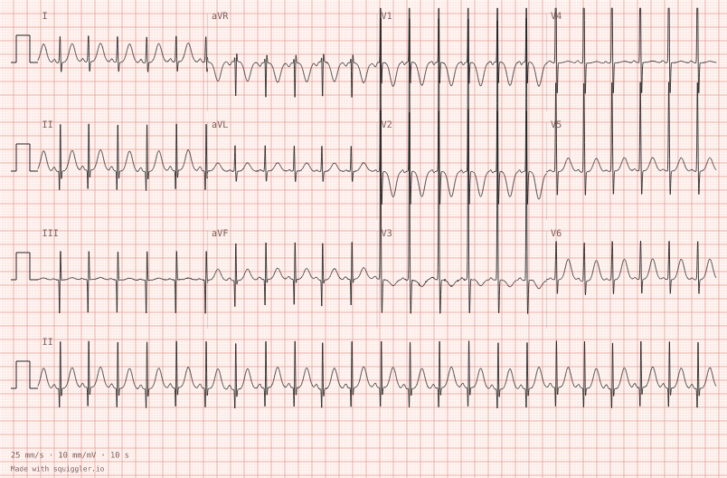 Infant, four months — synthetic ECG on millimetre paper