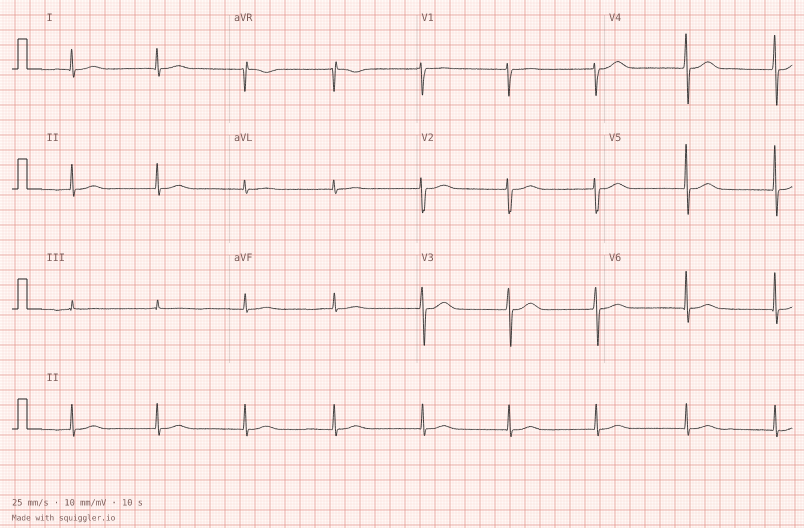 Junctional rhythm — synthetic ECG on millimetre paper