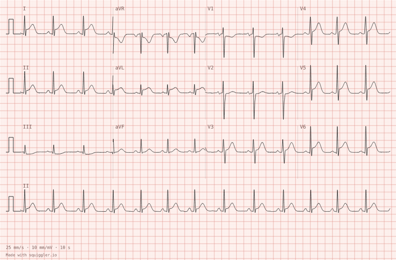 Lateral STEMI — synthetic ECG on millimetre paper