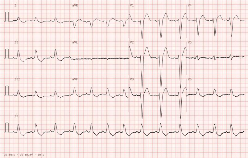 Left bundle branch block — synthetic ECG on millimetre paper