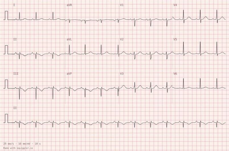 Left axis deviation — synthetic ECG on millimetre paper
