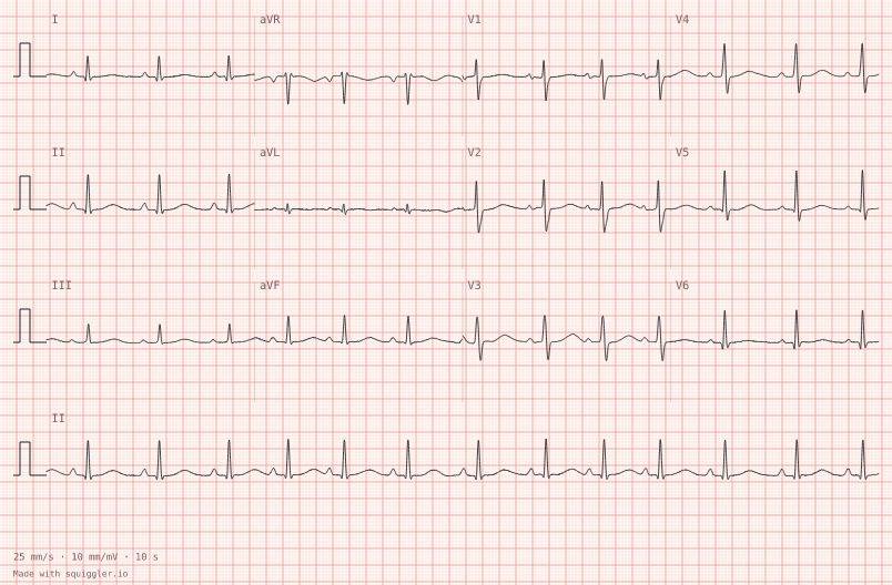 Long QT — synthetic ECG on millimetre paper