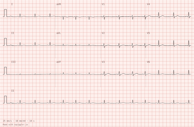 Low voltage — synthetic ECG on millimetre paper