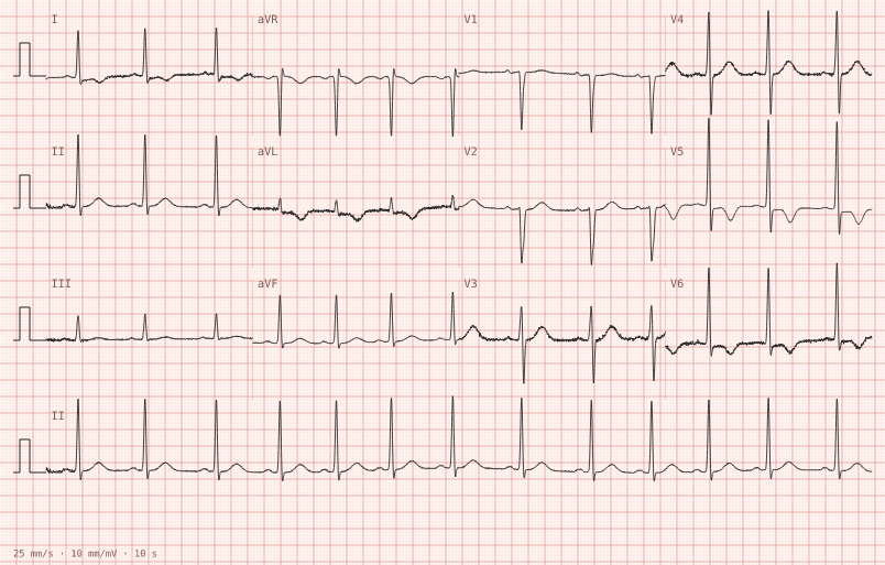 LVH with strain — synthetic ECG on millimetre paper