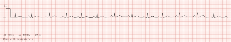 Mains interference — synthetic ECG on millimetre paper