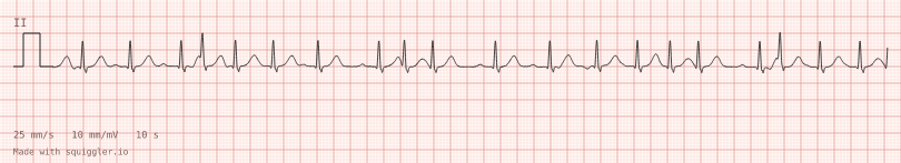 Multifocal atrial tachycardia — synthetic ECG on millimetre paper