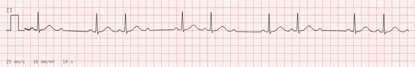 Mobitz II — synthetic ECG on millimetre paper