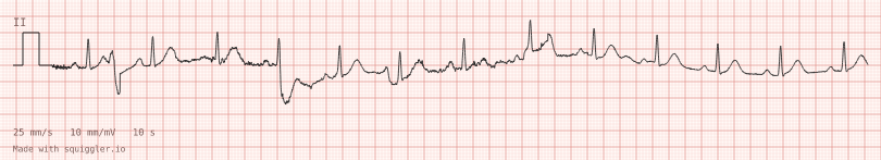 Movement artifact — synthetic ECG on millimetre paper