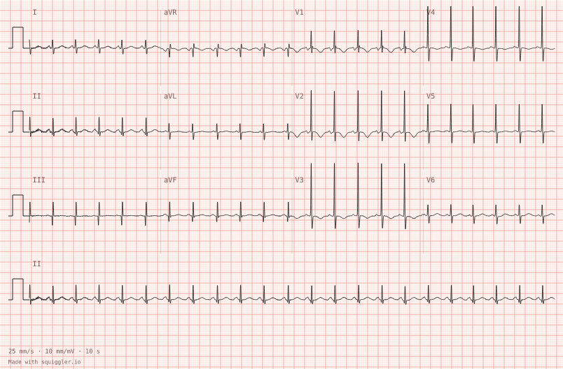 Newborn — synthetic ECG on millimetre paper