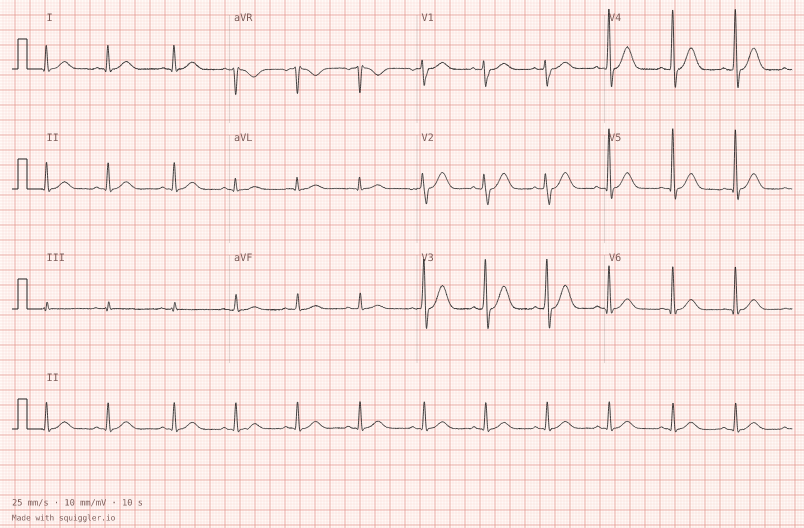 Normal twelve-lead — synthetic ECG on millimetre paper
