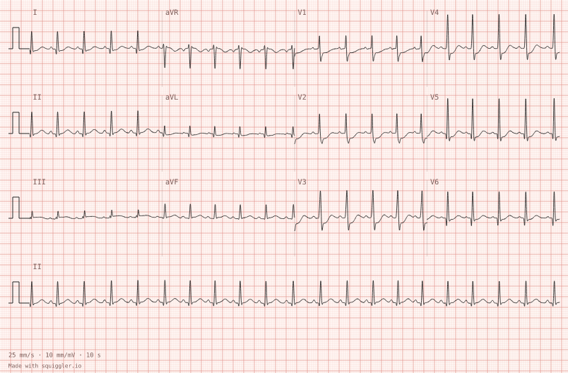 NSTEMI, ST depression — synthetic ECG on millimetre paper