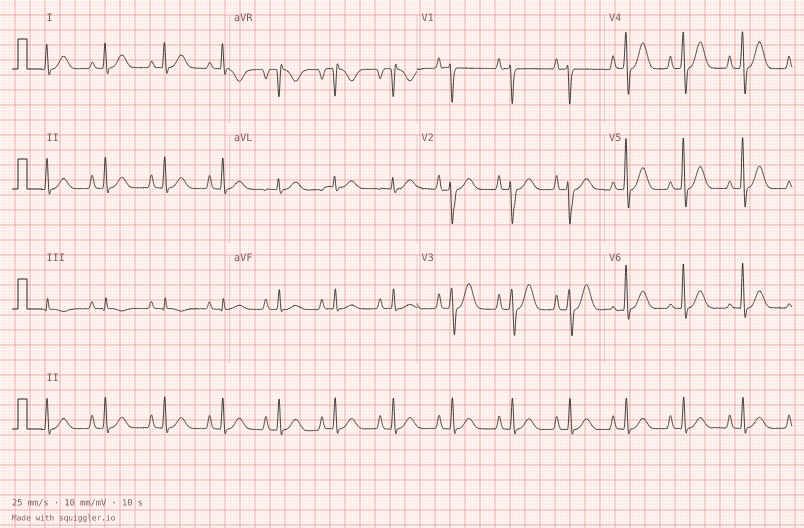 P pulmonale — synthetic ECG on millimetre paper
