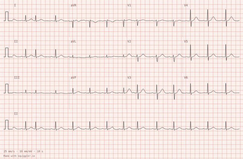 Atrial ectopics — synthetic ECG on millimetre paper