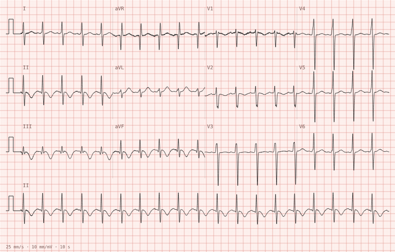 PE pattern (S1Q3T3) — synthetic ECG on millimetre paper