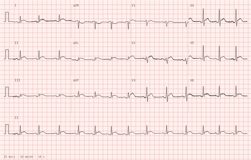 Pericarditis — synthetic ECG on millimetre paper