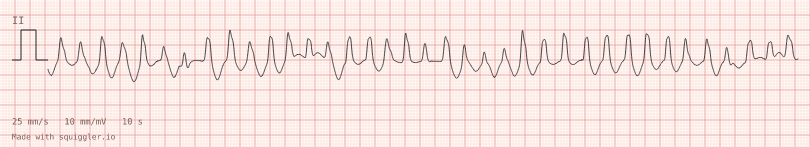Polymorphic VT — synthetic ECG on millimetre paper