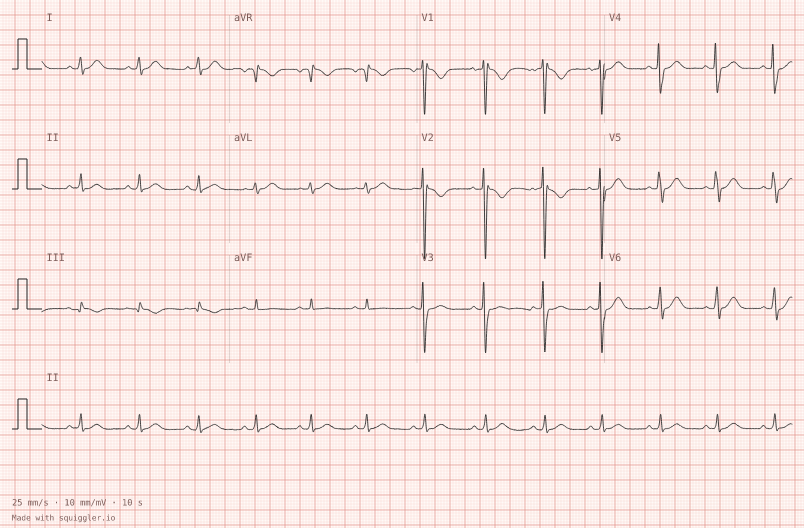 Poor R-wave progression — synthetic ECG on millimetre paper