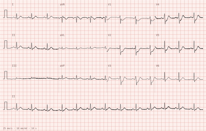 Posterior MI — synthetic ECG on millimetre paper