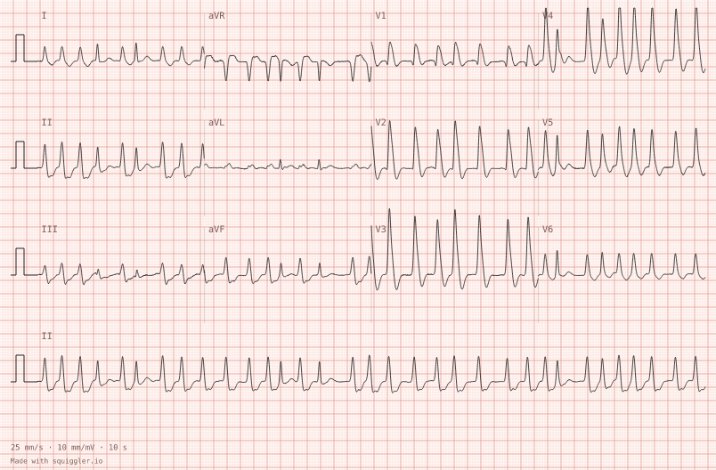 Pre-excited AF — synthetic ECG on millimetre paper